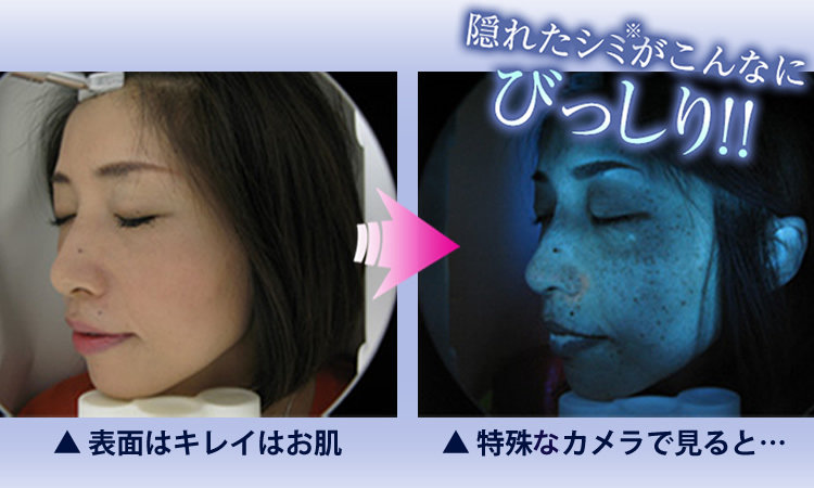 素肌の下に潜む 隠れシミの恐怖 知っておくべきケアとは 美肌アンサー